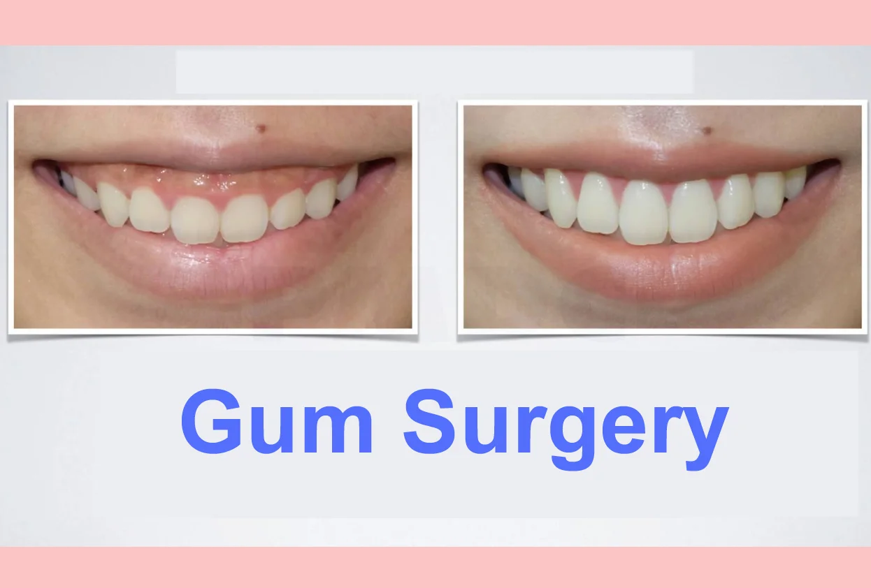 Gum Surgery