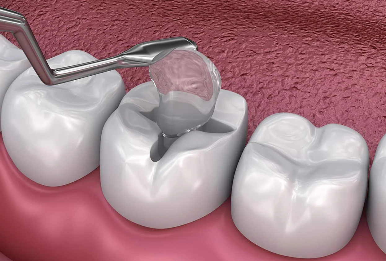 Dental Fillings