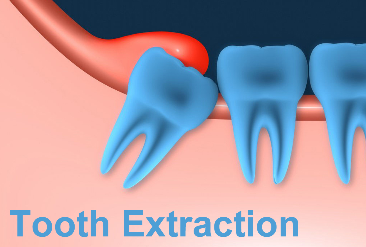 Tooth Extraction