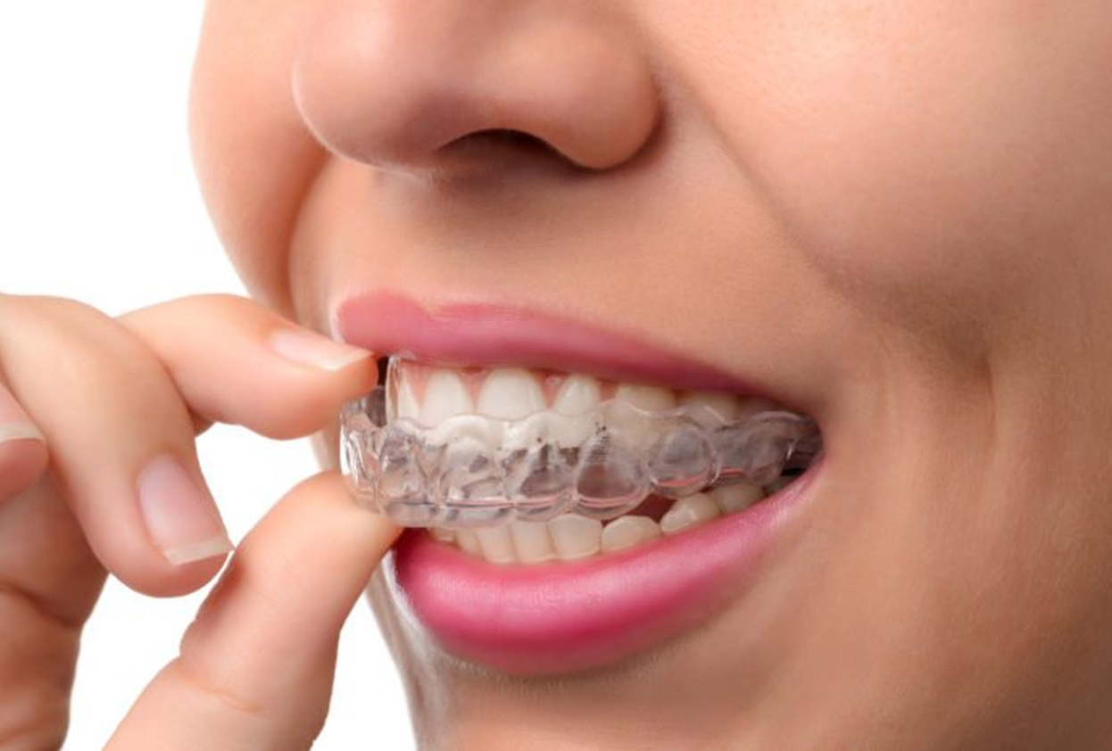 Correction of Maligned Teeth